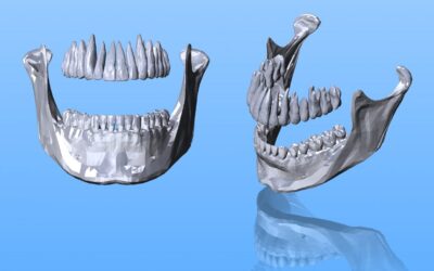 Dental Implant Development